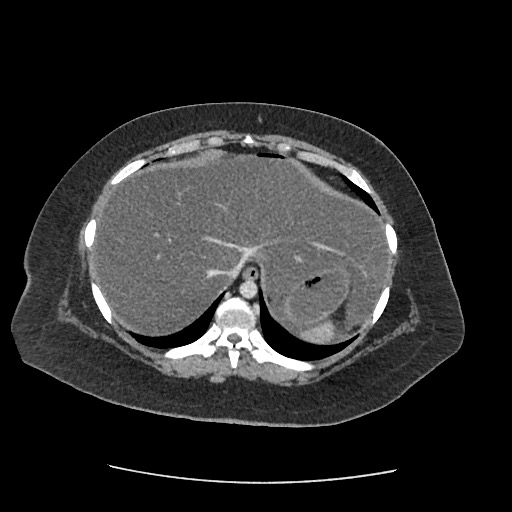 Bowel and splenic infarcts in acute lymphocytic leukemia (Radiopaedia 61055-68915 A 24).jpg