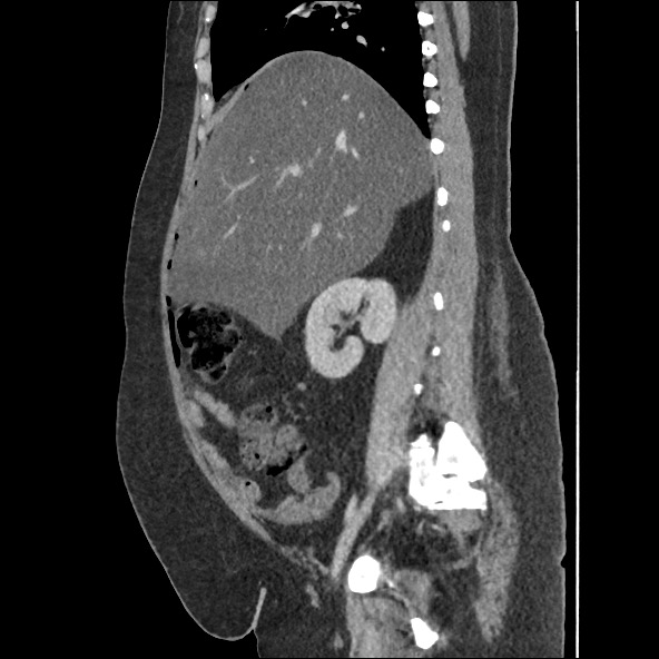 Bowel and splenic infarcts in acute lymphocytic leukemia (Radiopaedia 61055-68915 C 44).jpg