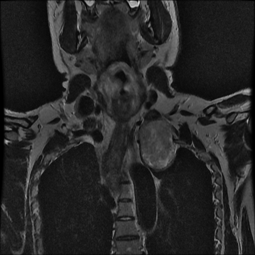File:Brachial plexus neurofibroma (Radiopaedia 28030-28291 Coronal T2 7).png