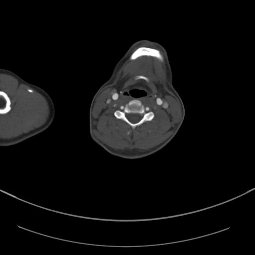 Brachiocephalic trunk pseudoaneurysm (Radiopaedia 70978-81191 Axial bone window 20).jpg
