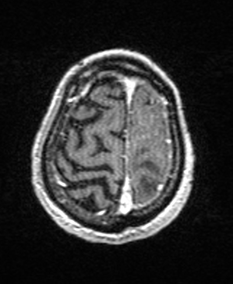 Brain abscess with dual rim sign (Radiopaedia 87566-103938 Axial T1 C+ 140).jpg