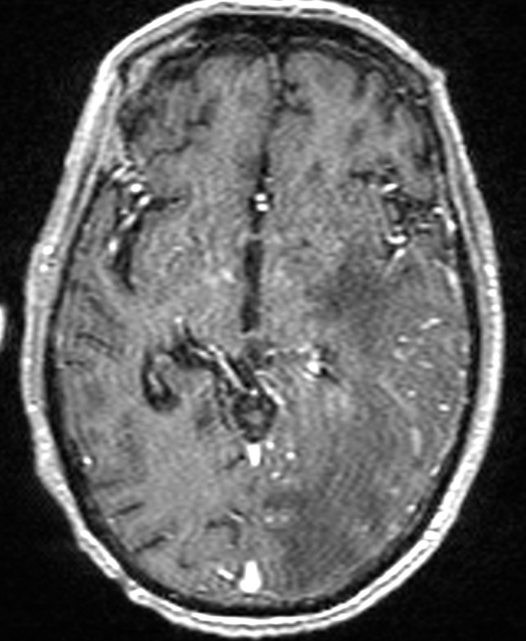 Brain abscess with dual rim sign (Radiopaedia 87566-103938 Axial T1 C+ 78).jpg