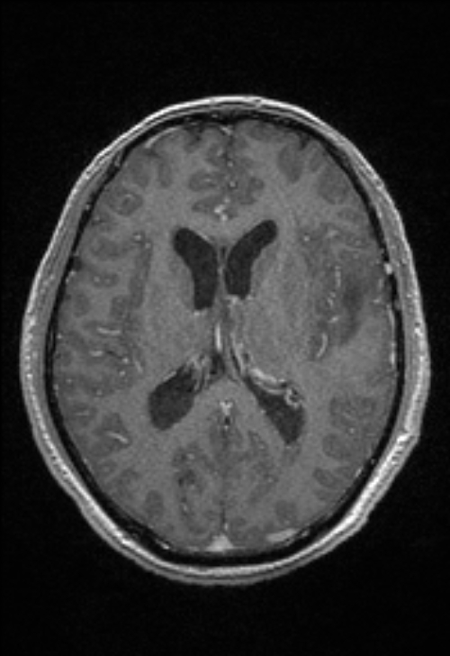 Brain abscess with ventriculitis (Radiopaedia 85703-101495 Axial T1 C+ 102).jpg