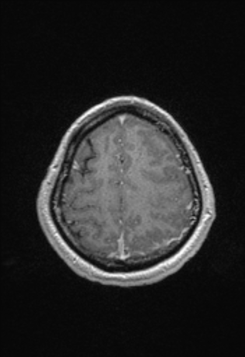 Brain abscess with ventriculitis (Radiopaedia 85703-101495 Axial T1 C+ 143).jpg