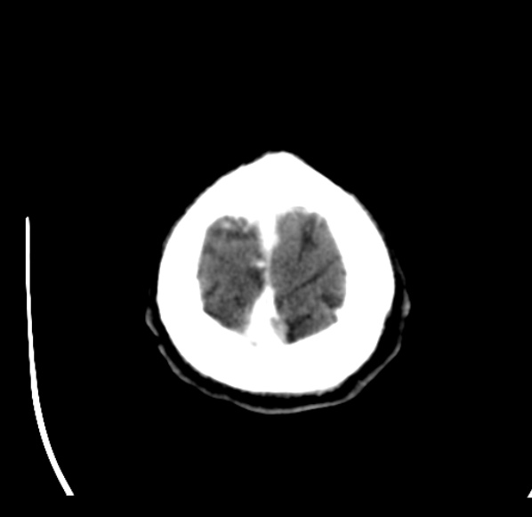 File:Brain metastases from lung cancer (Radiopaedia 24480-24781 Axial C+ delayed 60).jpg