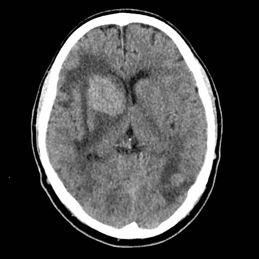 File:Brain metastases from lung cancer (Radiopaedia 83839-99027 Axial non-contrast 17).jpg