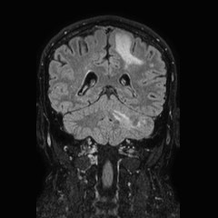 File:Brain metastases from lung cancer (Radiopaedia 83839-99028 Coronal FLAIR 54).jpg