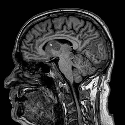 Brain metastases from lung cancer (Radiopaedia 83839-99028 Sagittal T1 59).jpg