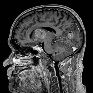 Brain metastases from lung cancer (Radiopaedia 83839-99028 Sagittal T1 C+ 27).jpg