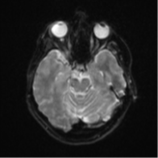 File:Brain metastasis (sarcoma) (Radiopaedia 47576-52209 Axial DWI 10).png