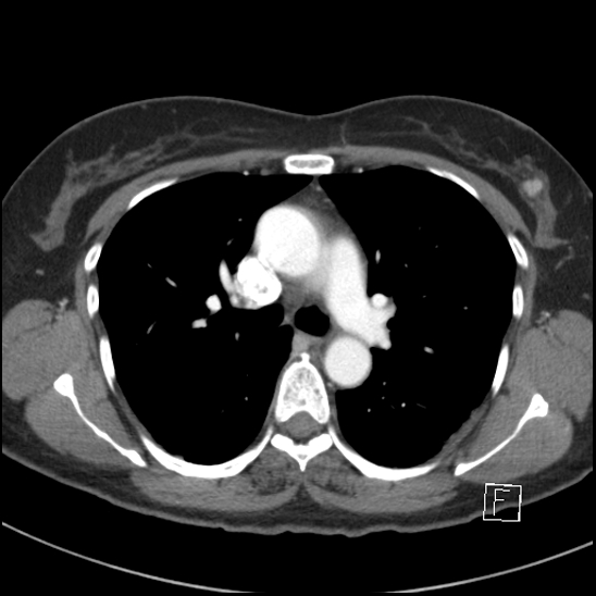 File:Breast metastases from renal cell cancer (Radiopaedia 79220-92225 A 38).jpg