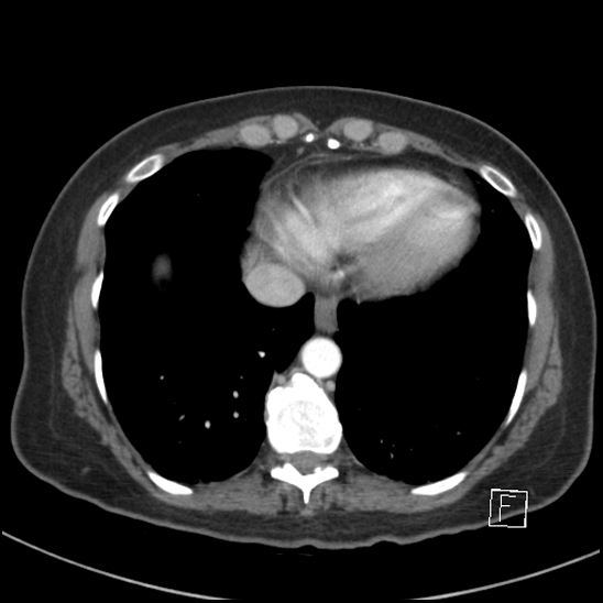 File:Breast metastases from renal cell cancer (Radiopaedia 79220-92225 A 71).jpg