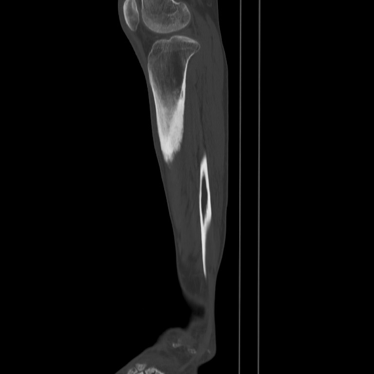 Brodie abscess - tibia (Radiopaedia 66028-75204 Sagittal bone window 54).jpg
