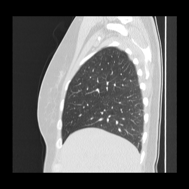 Bronchial atresia (Radiopaedia 22965-22992 Sagittal lung window 44).jpg