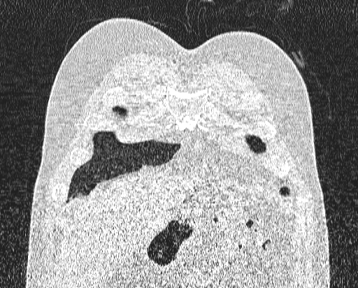 Bronchial atresia (Radiopaedia 58271-65417 Coronal lung window 4).jpg