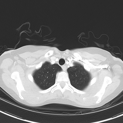 File:Bronchial atresia (Radiopaedia 73677-84470 Axial lung window 10).jpg