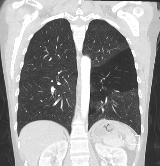 File:Bronchial atresia (Radiopaedia 73677-84470 Coronal lung window 22).jpg