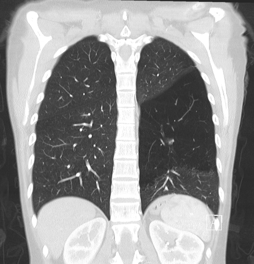 File:Bronchial atresia (Radiopaedia 73677-84470 Coronal lung window 25).jpg