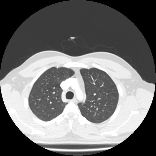 File:Bronchial carcinoid (Radiopaedia 80013-93291 Axial lung window 20).jpg