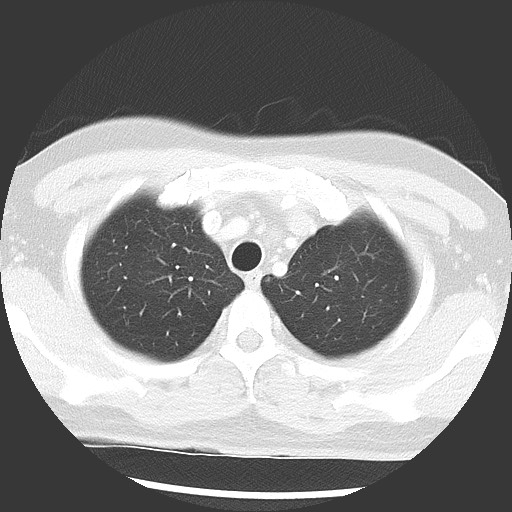 Bronchial carcinoid tumor (Radiopaedia 67377-76764 Axial lung window 15).jpg