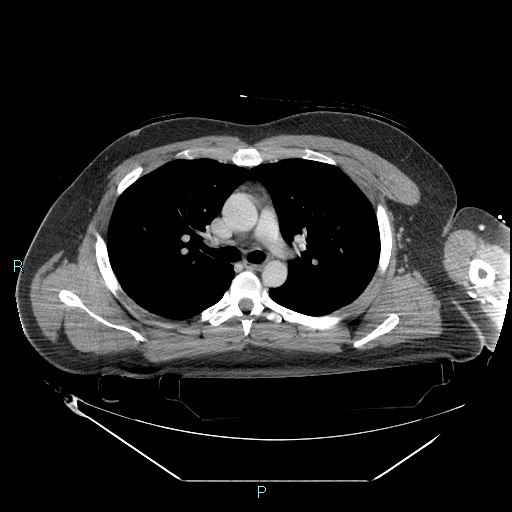 Bronchial carcinoid tumor (Radiopaedia 78272-90870 C 49).jpg