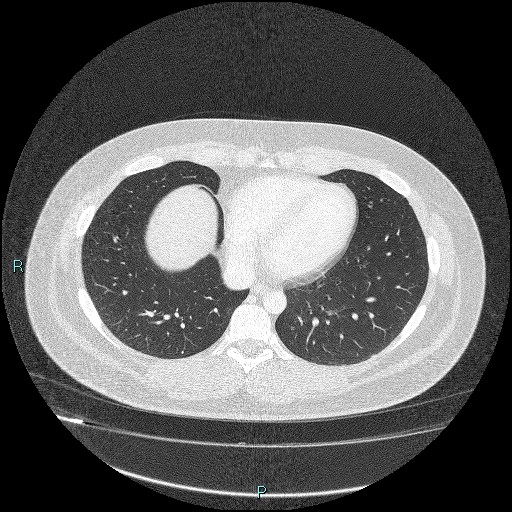 Bronchial carcinoid tumor (Radiopaedia 78272-90875 Axial lung window 37).jpg