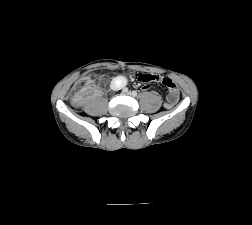 File:Bronchiectasis in Crohn disease (Radiopaedia 60311-67977 B 113).jpg