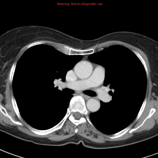 File:Bronchoalveolar carcinoma (BAC) (Radiopaedia 13436-13392 B 24).jpg