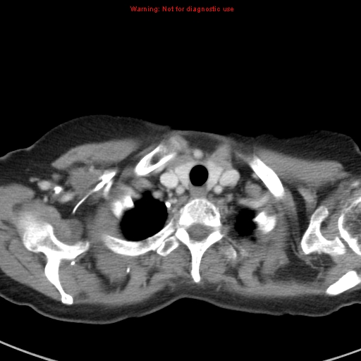 File:Bronchoalveolar carcinoma (BAC) (Radiopaedia 13436-13392 B 4).jpg