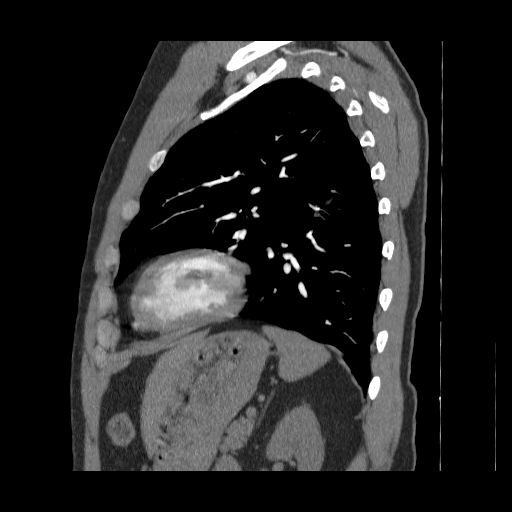 File:Bronchogenic carcinoma (Radiopaedia 47026-51562 Sagittal C+ CTPA 2).jpg