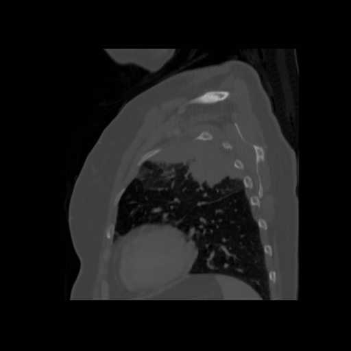 Bronchogenic carcinoma (Radiopaedia 73497-84262 Sagittal bone window 119).jpg