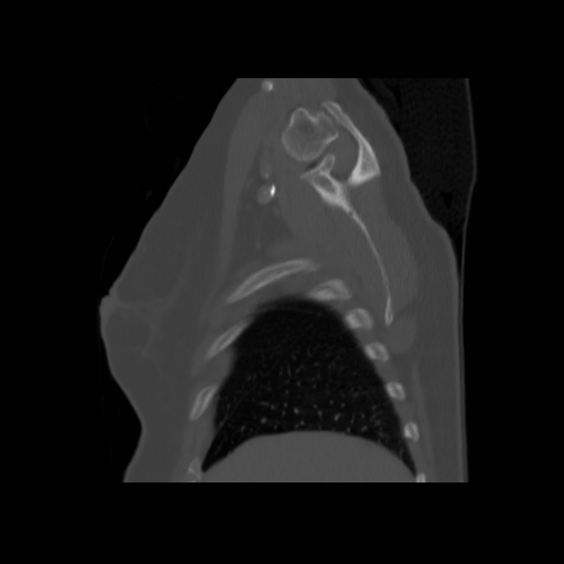 Bronchogenic carcinoma (Radiopaedia 73497-84262 Sagittal bone window 31).jpg