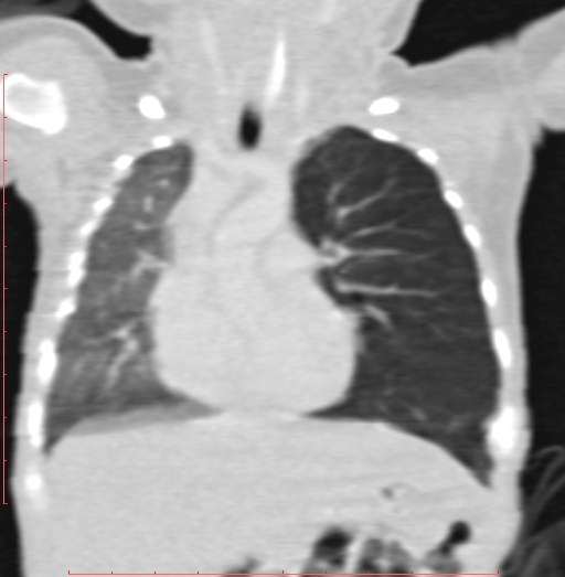 Bronchogenic cyst (Radiopaedia 78599-91409 Coronal lung window 103).jpg