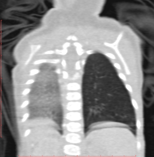 Bronchogenic cyst (Radiopaedia 78599-91409 Coronal lung window 178).jpg