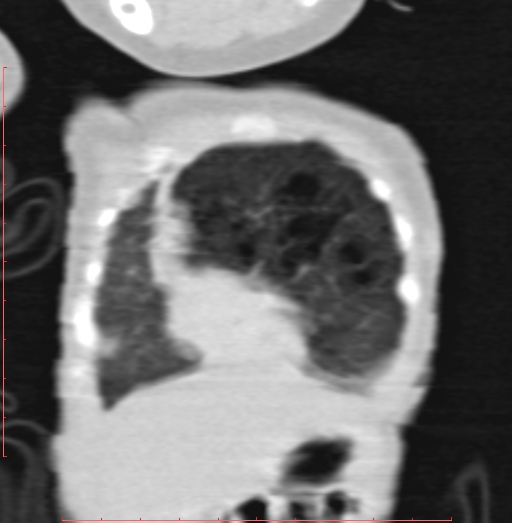 File:Bronchogenic cyst (Radiopaedia 78599-91409 Coronal lung window 39).jpg