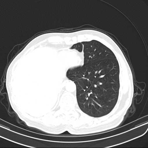 File:Bronchopleural fistula - postoperative complication (Radiopaedia 21020-20947 Axial lung window 43).jpg