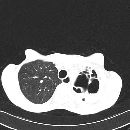 File:Bronchopleural fistula secondary to tuberculosis (Radiopaedia 20415-20322 Axial lung window 17).jpg