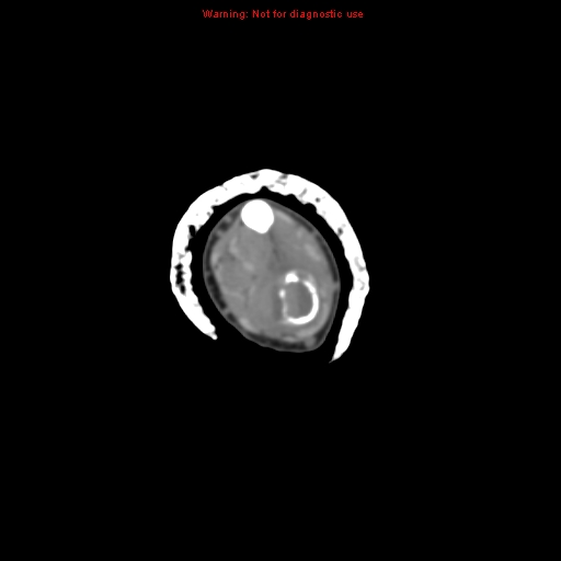 Brown tumor (Radiopaedia 12460-12694 Axial non-contrast 55).jpg