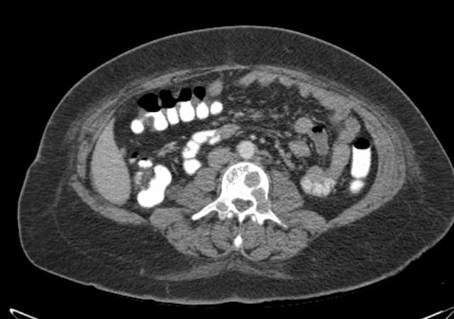 File:Brown tumors compressing the spinal cord (Radiopaedia 68442-77988 E 65).jpg