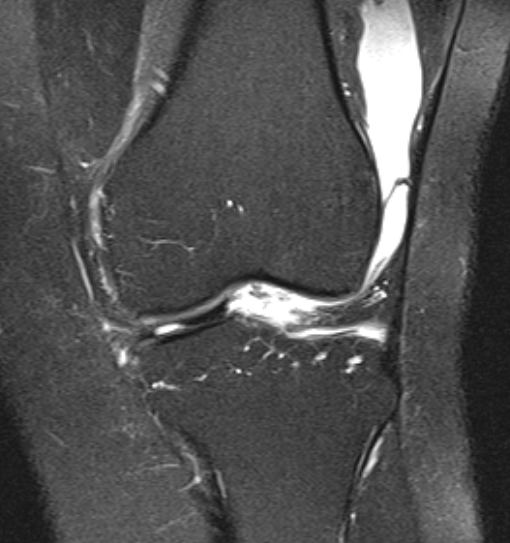 File:Bucket handle tear - medial meniscus (Radiopaedia 79028-91942 Coronal PD fat sat 14).jpg