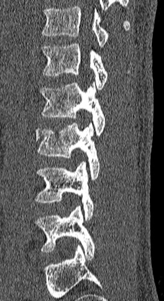 Burst fracture (Radiopaedia 53373-59357 Sagittal bone window 20).jpg