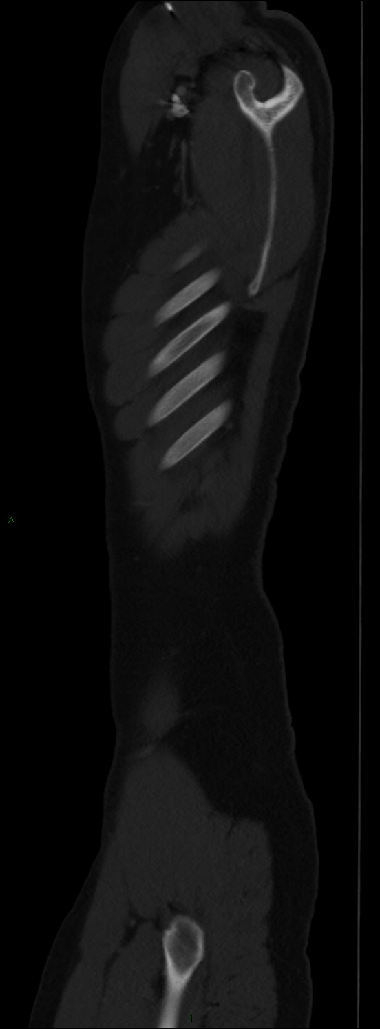 Burst fracture (Radiopaedia 83168-97542 Sagittal bone window 23).jpg