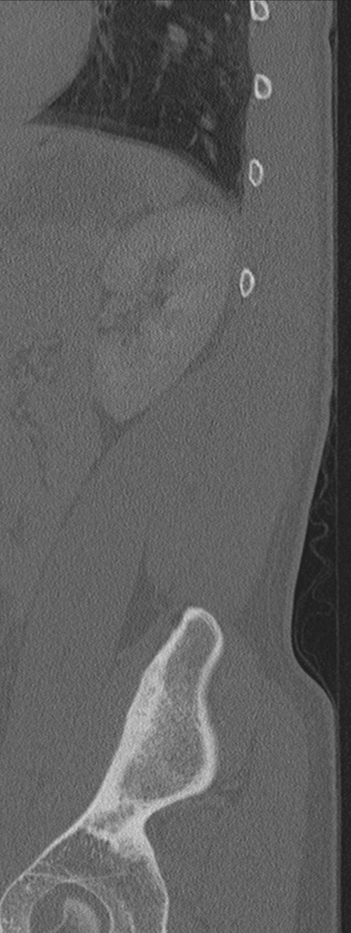 Burst fracture - T12 with conus compression (Radiopaedia 56825-63647 Sagittal bone window 6).png