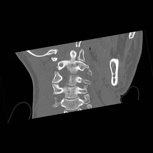 C1-C2 "subluxation" - normal cervical anatomy at maximum head rotation (Radiopaedia 42483-45607 Coronal non-contrast 26).jpg