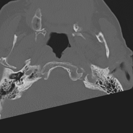 C2 fracture with vertebral artery dissection (Radiopaedia 37378-39199 Axial bone window 4).png
