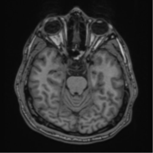 CNS vasculitis (Radiopaedia 55715-62263 Axial T1 3).png