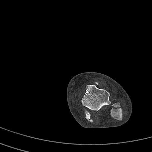 File:Calcaneal fracture - Sanders type 4 (Radiopaedia 90179-107370 Axial bone window 26).jpg