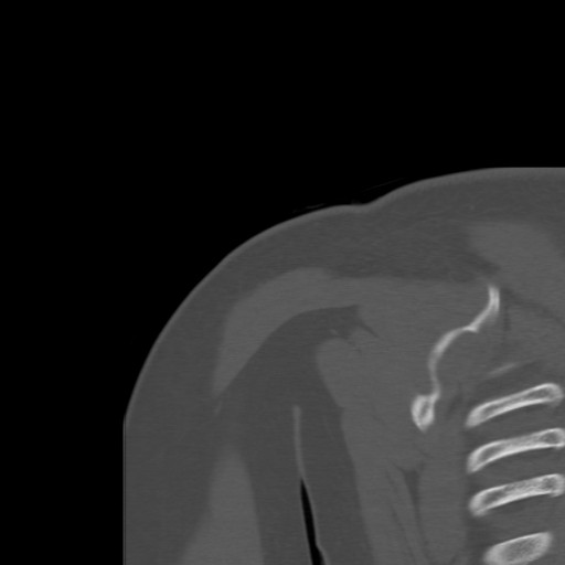 File:Calcific tendinitis of the infraspinatus tendon (Radiopaedia 87256-103539 Coronal bone window 48).jpg