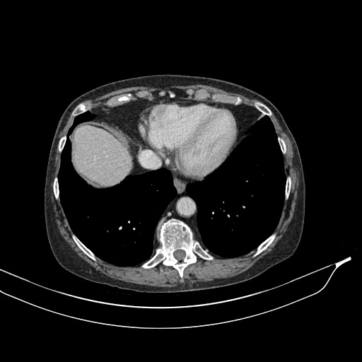 Calcified adrenal glands and Spigelian hernia (Radiopaedia 49741-54988 A 16).jpg