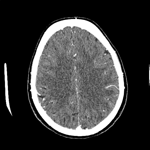 File:Calcified cerebral hydatid cyst (Radiopaedia 65603-74717 Axial with contrast 54).jpg